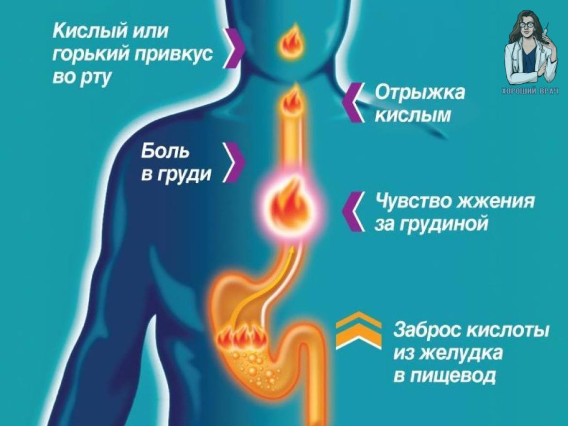 Давит в пищеводе. Симптомы изжоги желудка. Основные причины изжоги.