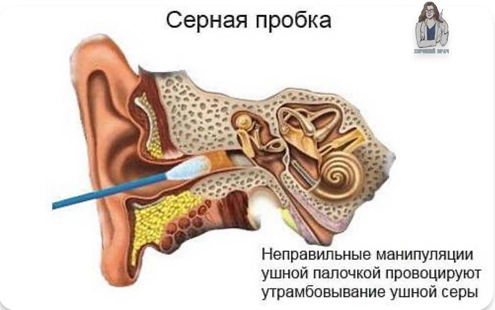 Застряла вата в ухе. Строение уха ушная пробка. Серная пробка на барабанной перепонке. Внутреннее ухо серная пробка.